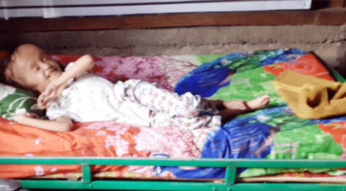 11 Tahun Terbaring di Tempat Tidur, Anak Pengidap Hidrosefalus Ini Butuh Bantuan Mektildis Oktaviana (12), saat ini masih terbaring sakit di rumahnya di Sokrutung, Desa Pantar, Kecamatan Komodo, Kabupaten Manggarai Barat.