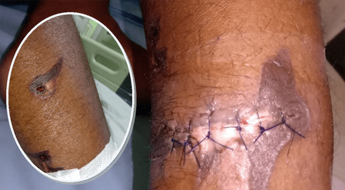 Dugaan Malpraktek di RSUD Bajawa, Operasi Usus Buntu Berujung Luka Pada Betis Pasien luka pasien RSUD Bajawa