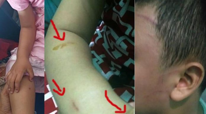 Polres Ende Diminta Tindak Tegas Aipda Gede Hermawan Rominto luka lecet, lebam dan luka bakar yang dialami Bayu dan Natasya